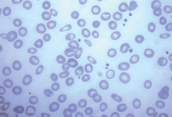 Figure 1. Blood film showing basophilic stippling