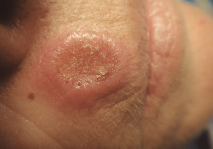 Figure 1. Asymptomatic ulcerated nodule localised above the upper lip with central crusting. The lesion had grown rapidly over a 3-week period