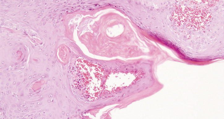 Figure 2. Well-differentiated squamous domized trial. Actas Dermosifiliogr 2011;102:605–15. epithelium exhibiting mild degree of pleomorphism with scattered keratin masses (hematoxylin-eosin staining, original magnification 10x)l