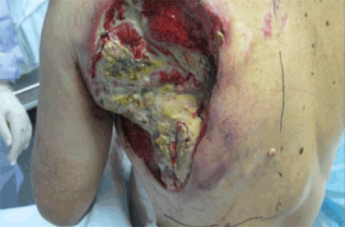 Figure 1A. Neoplastic-like ulcer