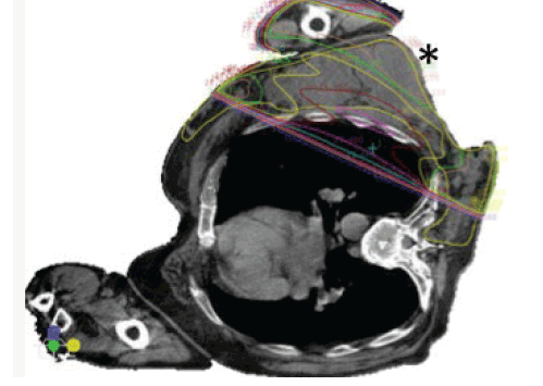 Figure 1C. CT planning axial slice