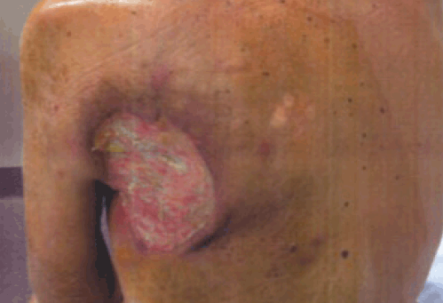 Figure 1D. Post-irradiation appearance of lesion