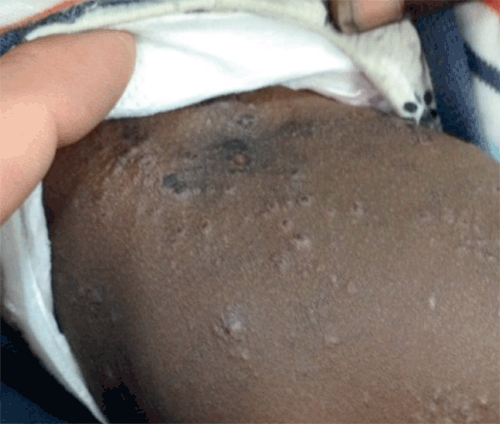 Figure 1. Rash in a child from a remote community