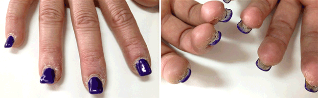 Figure 1. Clinical appearance of the patient's nails