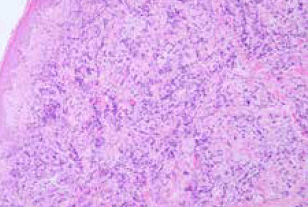 Figure 2. Haematoxylin and eosin stain of right chest wall punch biopsy showing invasion of dermis with cells consistent with invasive ductal carcinoma
