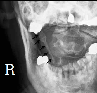 Figure 1. The right styloid process is extremely elongated on reverse Towne’s view (black arrows)