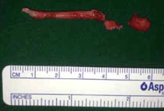 Figure 3. Photograph showing approximately 5 cm length of resected right styloid process