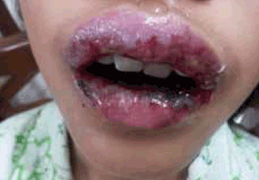 Figure 2. Progression to pan-mucositis of her mouth and throat