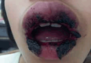 Figure 3. Typical bloody crusting of the lips