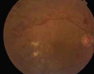 Figure 2. Diabetic retinopathy showing widespread retinal haemorrhages and hard exudates