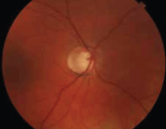 Figure 3. Advanced cupping of the optic nerve in glaucoma