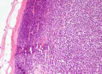 Figure 2. Lymph node with metastatic melanoma. Capsule and lymphoid tissue on the left and melanoma on the right