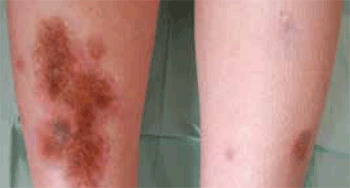 Figure 1a. Brownish, sharply demarcated, indurated plaque on the right shin.