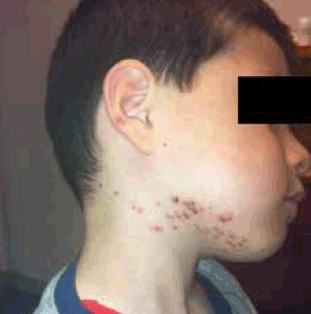 Figure 1. An erythematous maculopapular rash in a 5-year-old boy