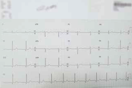 Figure 1. ECG of patient X