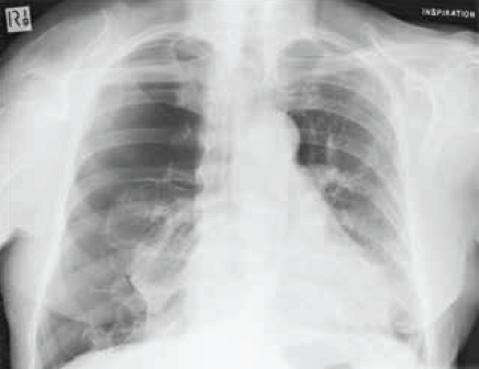Figure 1. Chest X-ray. An X-ray can be diagnostic for causes of chest pain as in this image, which shows spontaneous pneumothorax