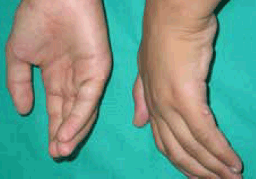 Figure 1. Soft, pink, asymptomatic and congenital papules in ulnar surface of proximal phalanx of the fifth fingers