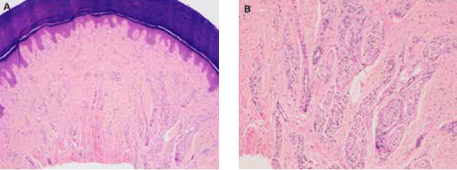 Figure 2. A. Hematoxylin-eosin staining showed the presence of a small wellcircumscribed dermal nodular tumor on fifth finger