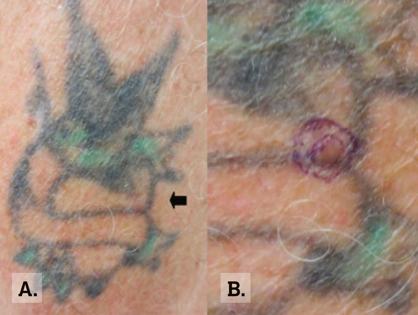 RACGP - Diagnostic difficulties in skin cancer detection within tattoos