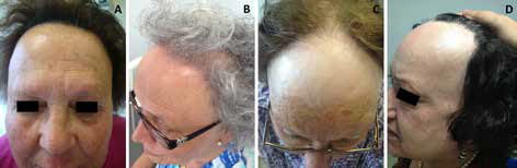 RACGP - Frontotemporal hair loss