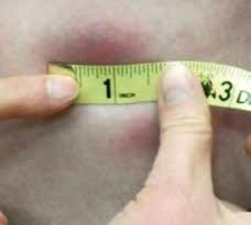 Figure 2. The lesions are indurated butdo not blanche upon pressure, measuringup to 4 cm (1.5 inches) in diameter
