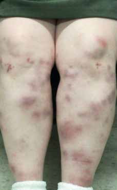 Figure 3. Patient reviewed at day 4,taking non-steroidal anti-inflammatorydrugs for symptomatic relief. Note thedeepening hue of the rash to purplebrown,similar to organising <br />bruises