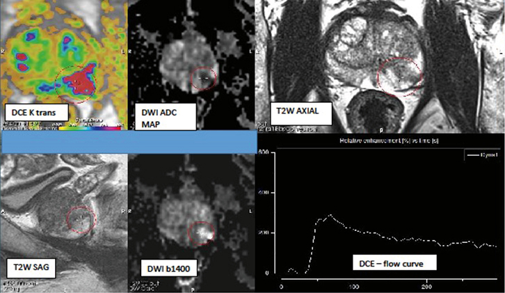 RACGP Multiparametric MRI In The Diagnosis Of Prostate Cancer RACGP Multiparametric MRI In The Diagnosis Of Prostate Cancer