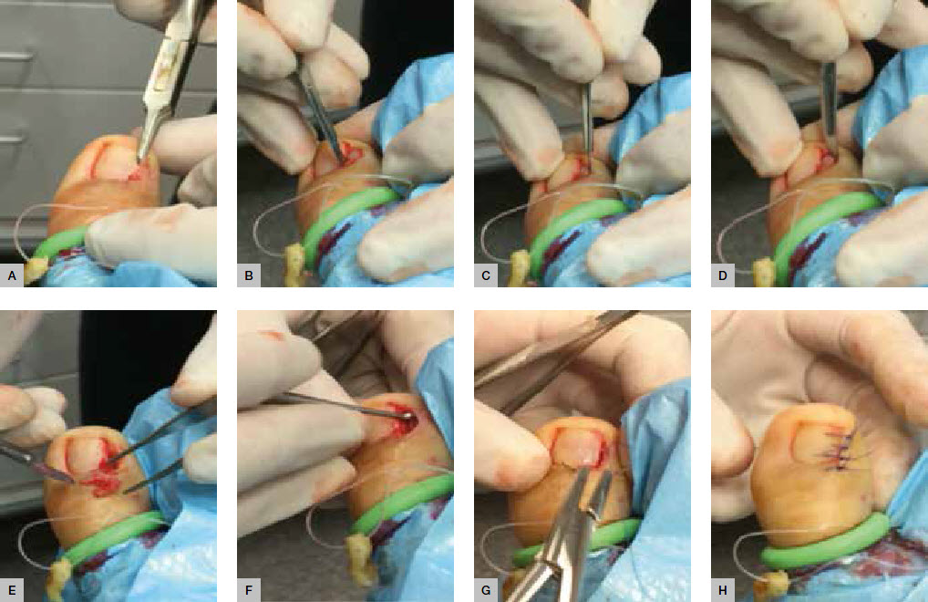 RACGP - Ingrown toenails: the role of the GP