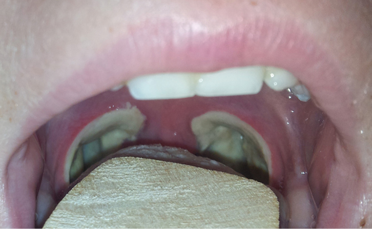 10 Best Tonsillectomy Recovery Images Tonsillectomy R - vrogue.co