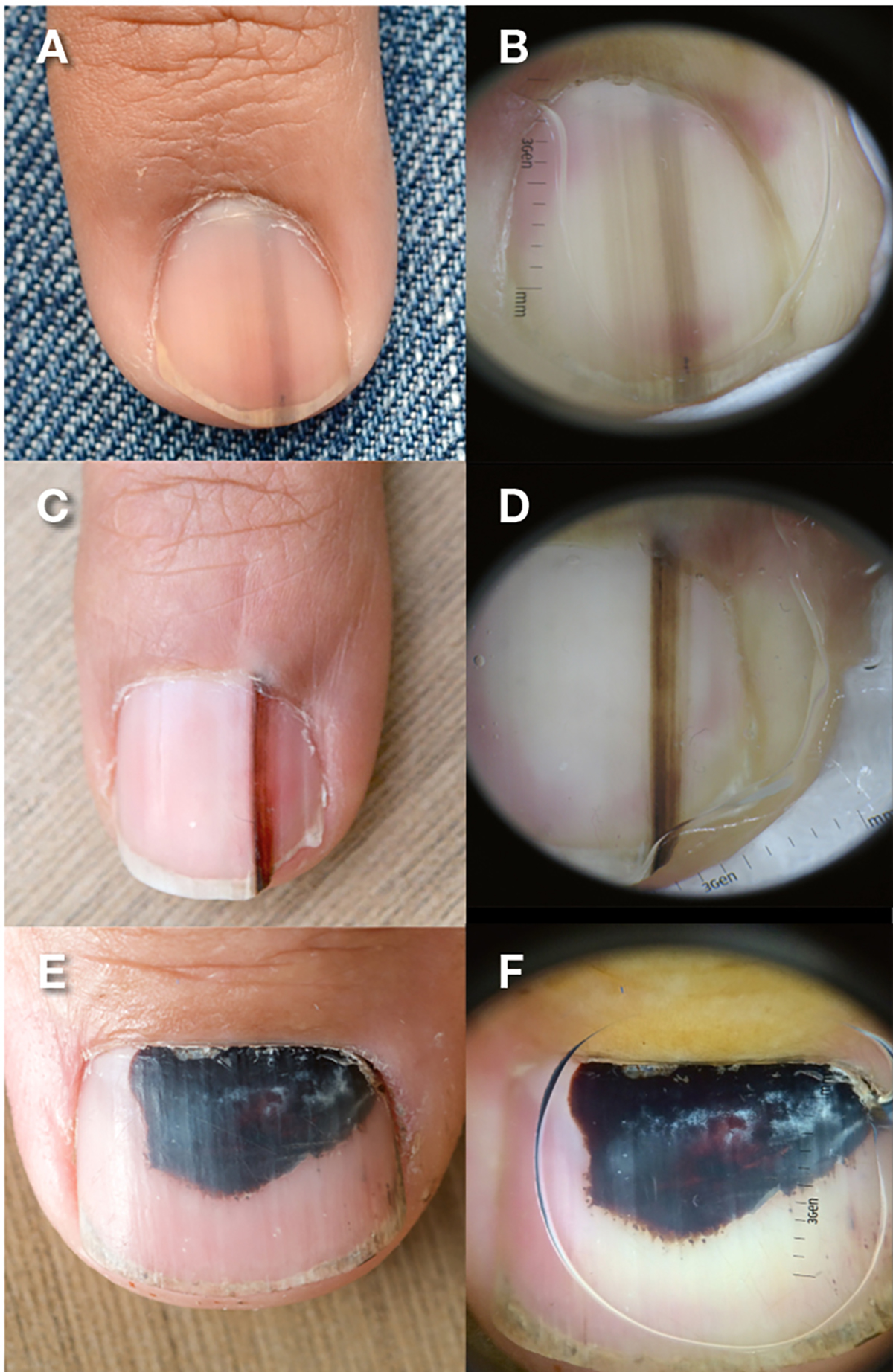 RACGP - Pigmented lesions of the nail bed – Clinical assessment and biopsy