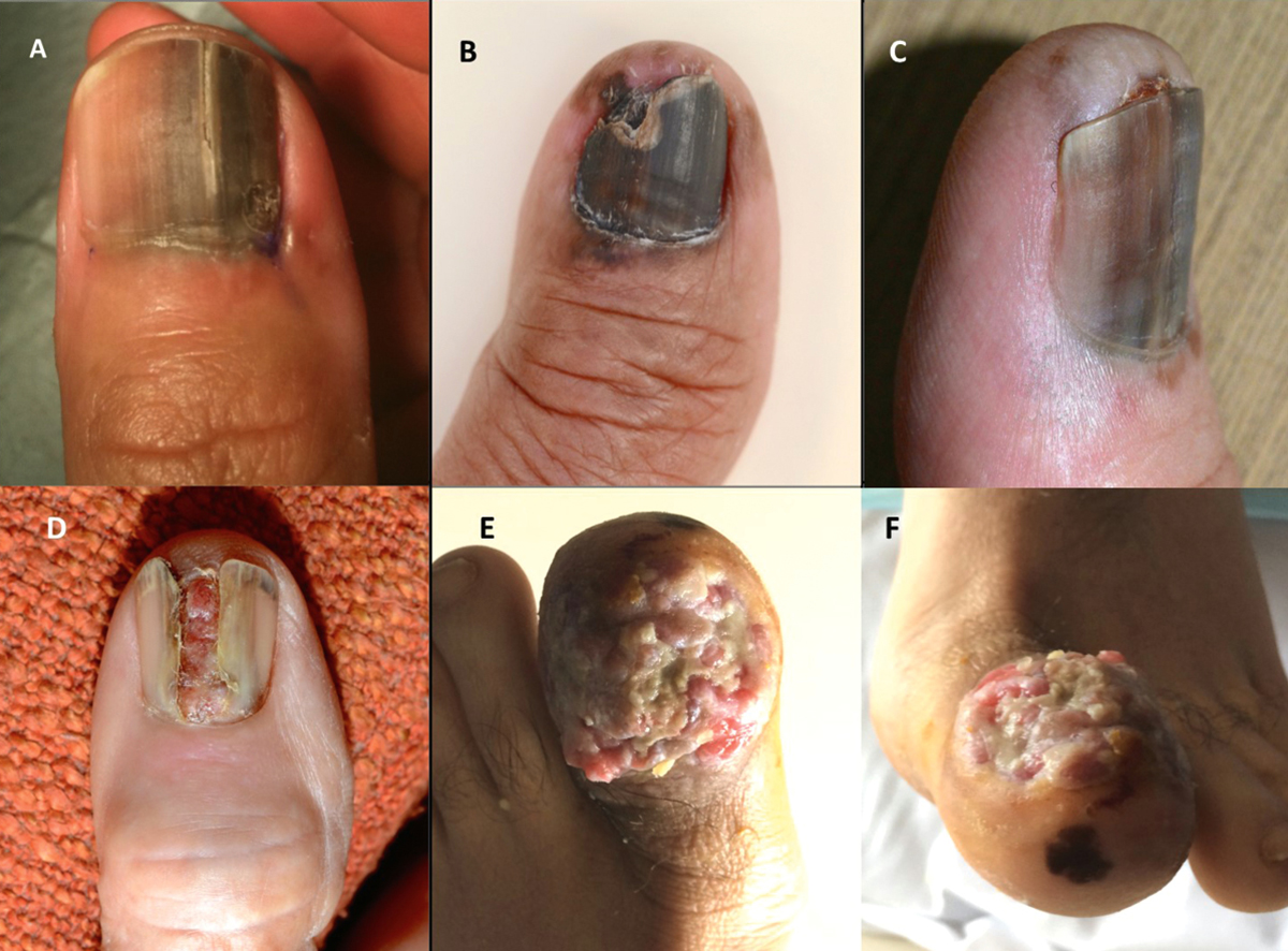 RACGP - Pigmented lesions of the nail bed – Clinical assessment and biopsy