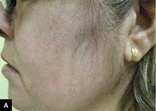 RACGP - Facial hair growth in a patient with psoriasis