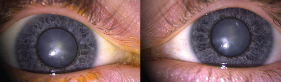 Figure 1 Appearance Of The Patients Right And Left Eyes