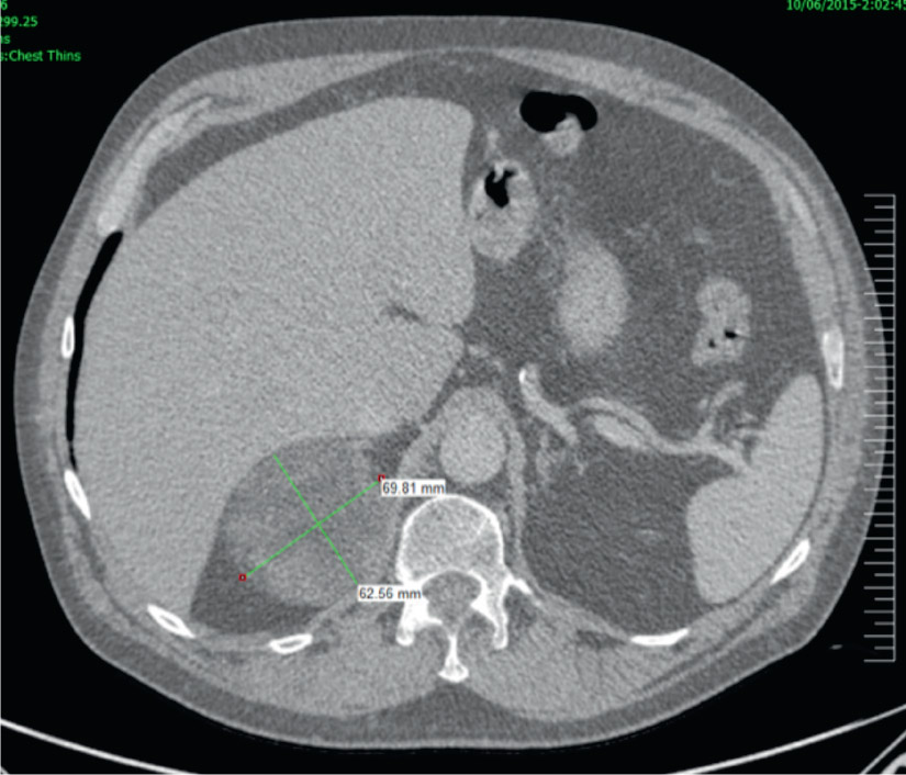 Figure 3 Adrenocortical Carcinoma