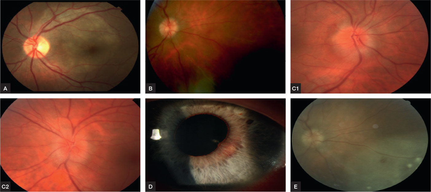 Figure 1 Presentations Of Ocular Syphilis In Four Individuals