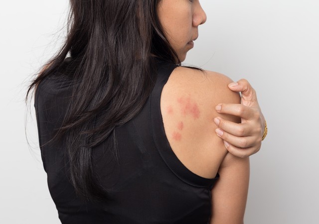 Mast Cell Activation Syndrome: An Immune System Stuck in Self-Defence
