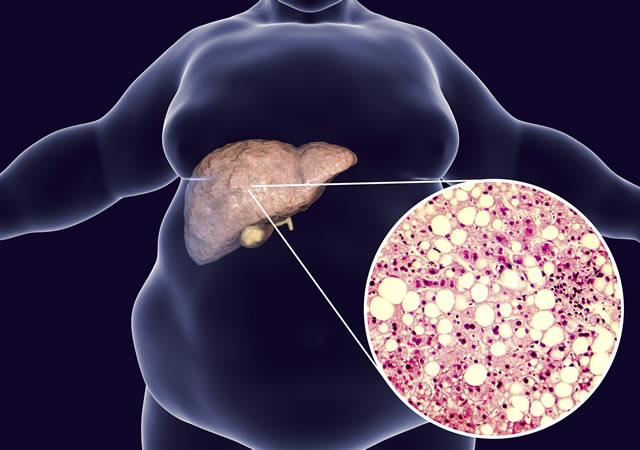 Liver Health in General Practice
