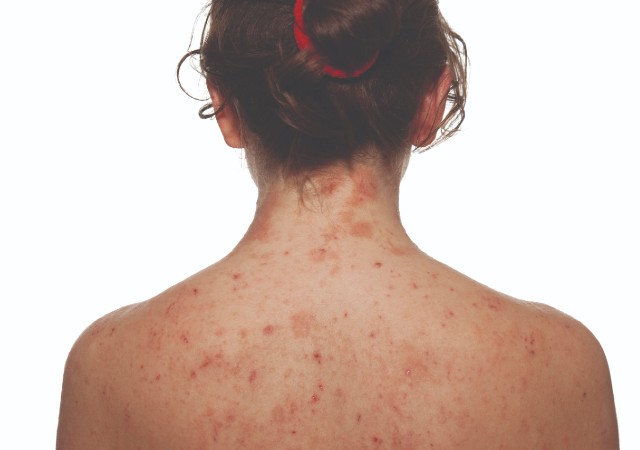 Syphilis Is Back: What GPs Need to Know About Testing, Treatment and Follow-Up